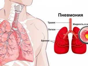 Рекомендации по профилактике пневмонии